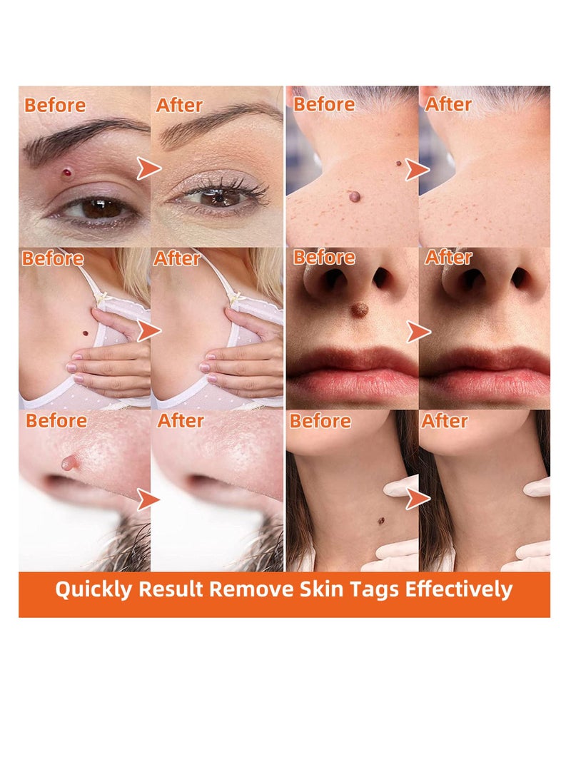 Kanza Micro Skin Tag Removal Kit - Painless Skin Tag Remover for Most Body Parts - Safe for Small (2mm) to Medium (5mm) Skin Tags  - Image 4