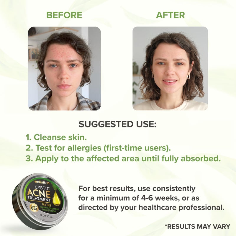 WELLUTION Cystic Acne Spot Treatment â€“ Tea Tree Acne Cream â€“ Fast-Acting Acne Spot Corrector for Face, Pimples & Blemishes â€“ Non-Greasy, Gentle Formula â€“ 1oz â€“ by WELLUTION - Image 5