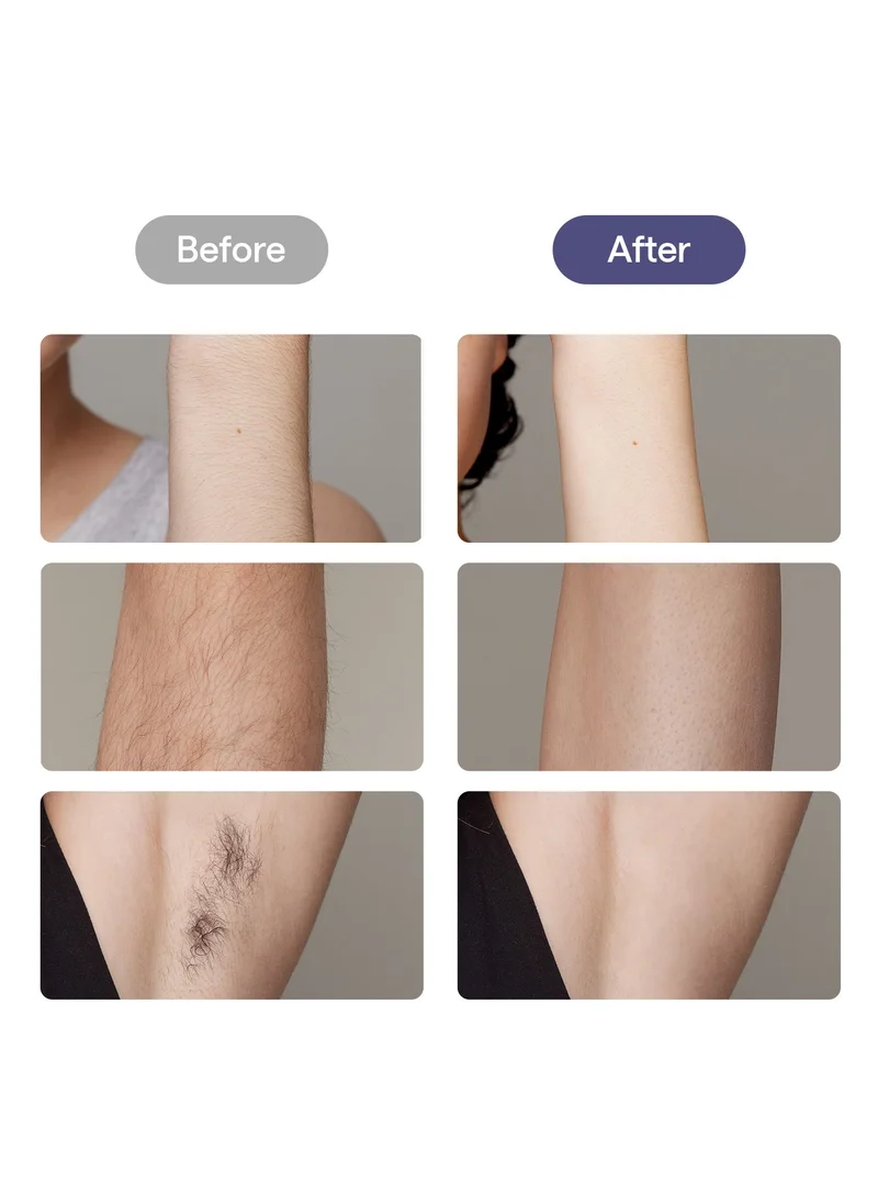 Ulike Ulike Laser Hair Removal, Air 10 IPL Hair Removal for Women and Men, 65°F Ice-Cooling Contact, Dual Lights, Skin Sensor & SHR Mode* for Nearly Painless, Effective & Long-Lasting Hair Removal from Home