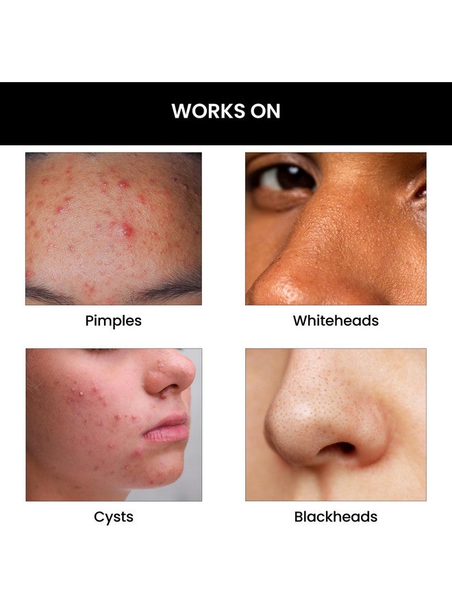 THRIVECO Goodbye Acne Kit Antiacne Serum (30Ml) And Face Wash (100Ml) Reduces Pimples Acne Marks & Sebum Production With Diacnemidetm Azelaic Acid Witch Hazel Niacinamide & Zinc Pca For Women & Men - Image 4