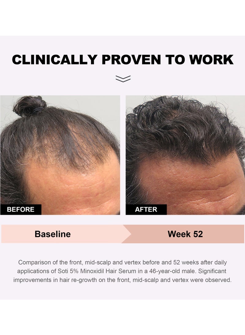 SOTI - Soti Minoxidil 5% Hair Growth, Hair Loss Regrowth Serum 60ml. Made in USA! Dermatologists Recommended. Ginseng and Biotin Extra Strength Formula (1 Pack) - Image 1