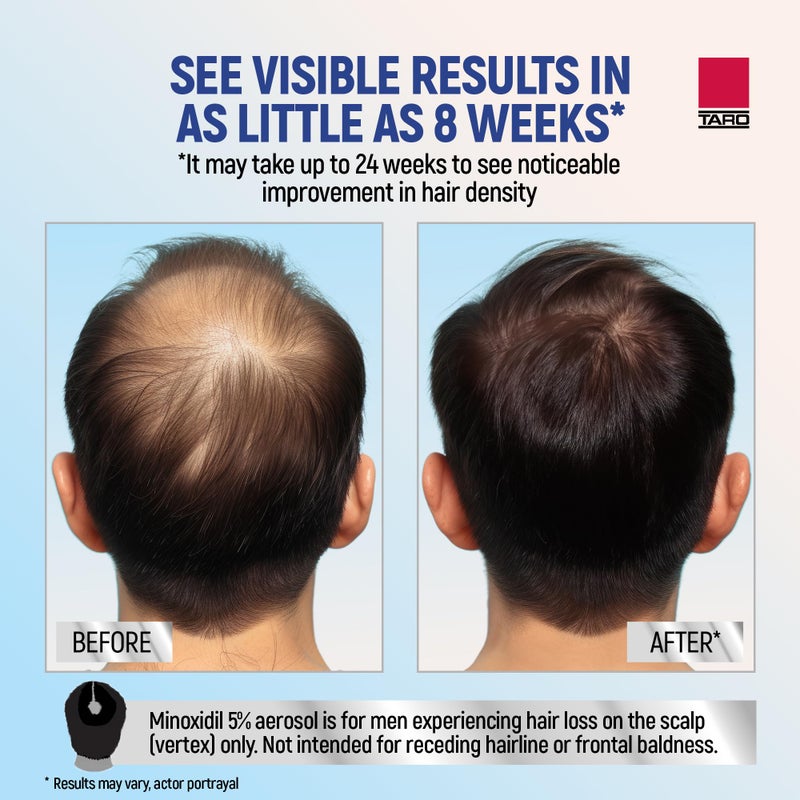 Taro Minoxidil for Men, 2.11 Oz (1 Month Supply) Clinically Proven to Regrow Hair, Topical Aerosol Foam 5%, Hair Thinning Treatment - Image 3