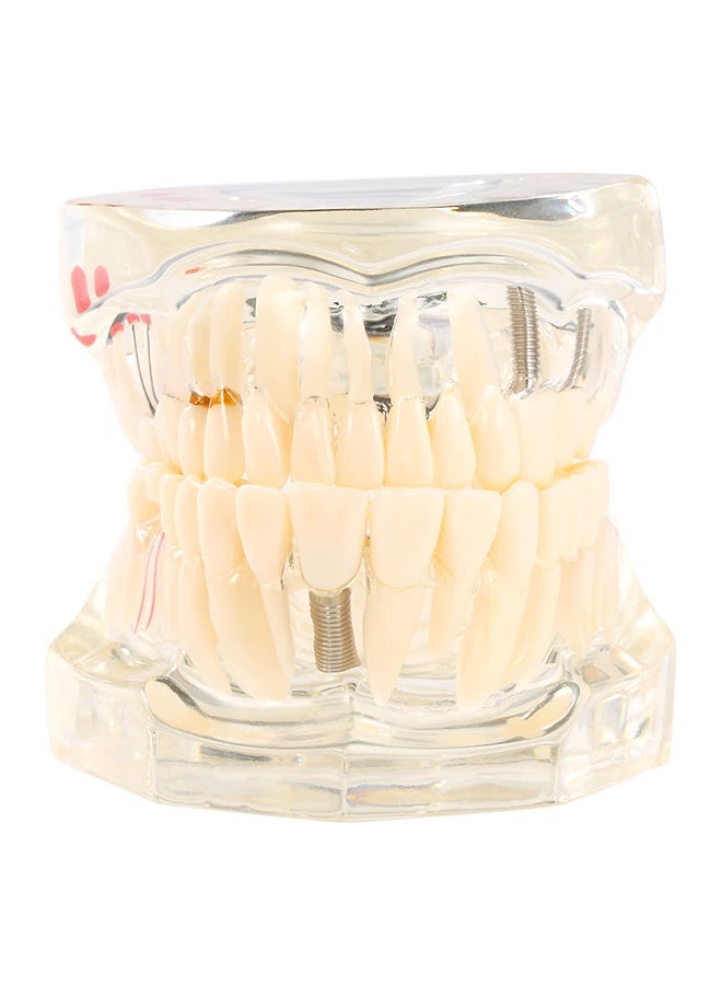 Dental Implantation Disease Teeth Model Multicolour - Image 1