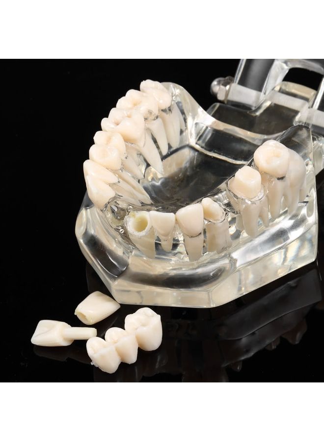 Dental Implantation Disease Teeth Model Multicolour - Image 2