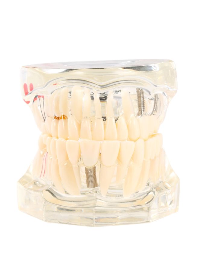 Dental Implantation Disease Teeth Model Multicolour - Image 5