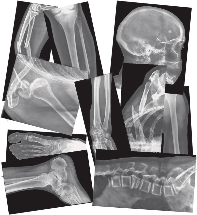 Roylco Broken Bones X-Ray Set for Educational Play - Image 1