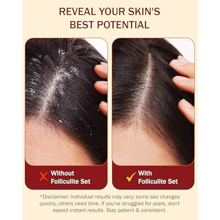 e70 Folliculitis Treatment Shampoo with 3% BHA, Salicylic Acid, Tea Tree Oil & Chamomile Extracts - Anti Itch Shampoo for women & men with Irritated Flaky Scalp Treatment, Made in USA by e70, 8 fl oz - Image 5