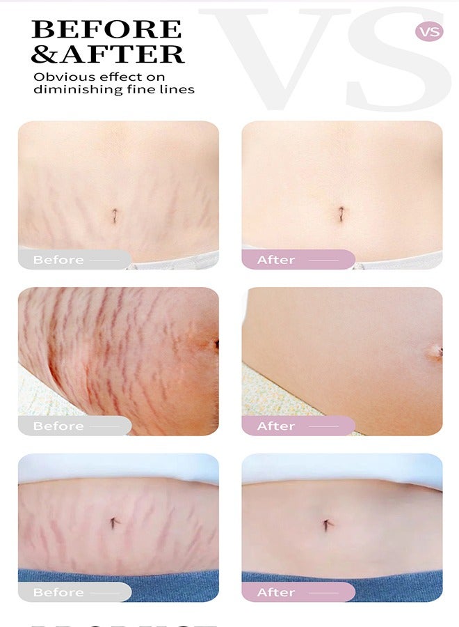 RtopR Mango Pregnancy Scars Cream For Maternity Repair Stretch Marks Enhance Skin Elasticity, Can Promote Cell Regeneration, Repair Necrotic Cells, Designed For Mother's Stretch Marks - Image 4