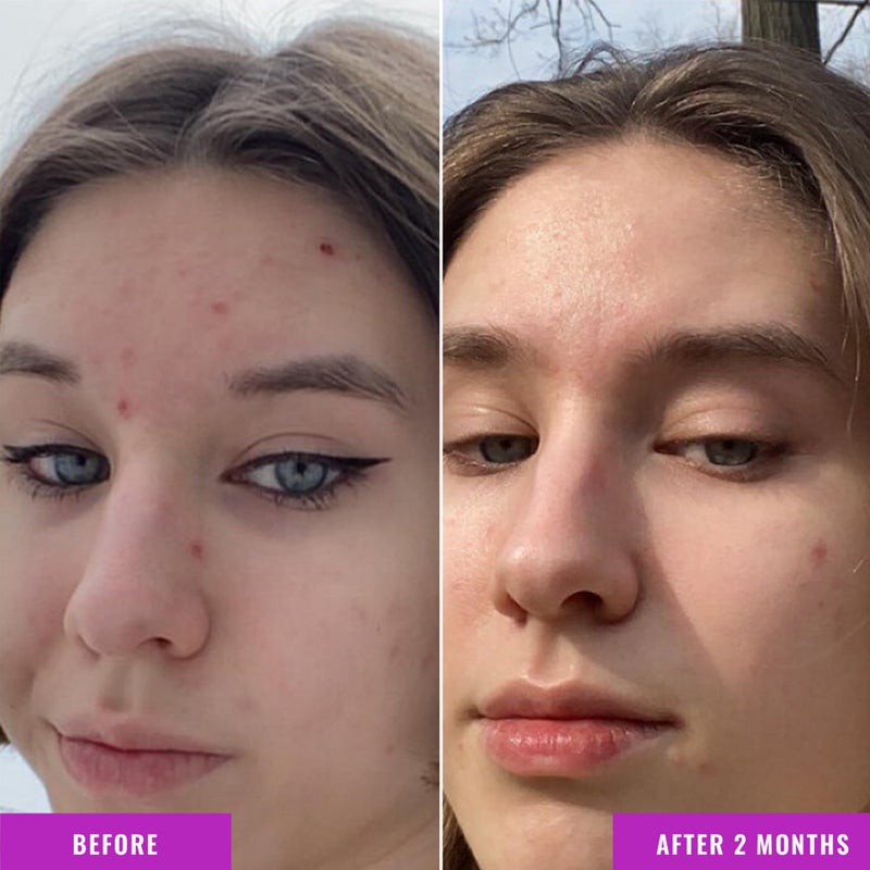 Good Molecules Niacinamide Serum - 10% Niacinamide to Target Acne, Nourishment, and Skin Tone - Ultra Hydrating Serum and Brightening Skin Care for Face - Image 4