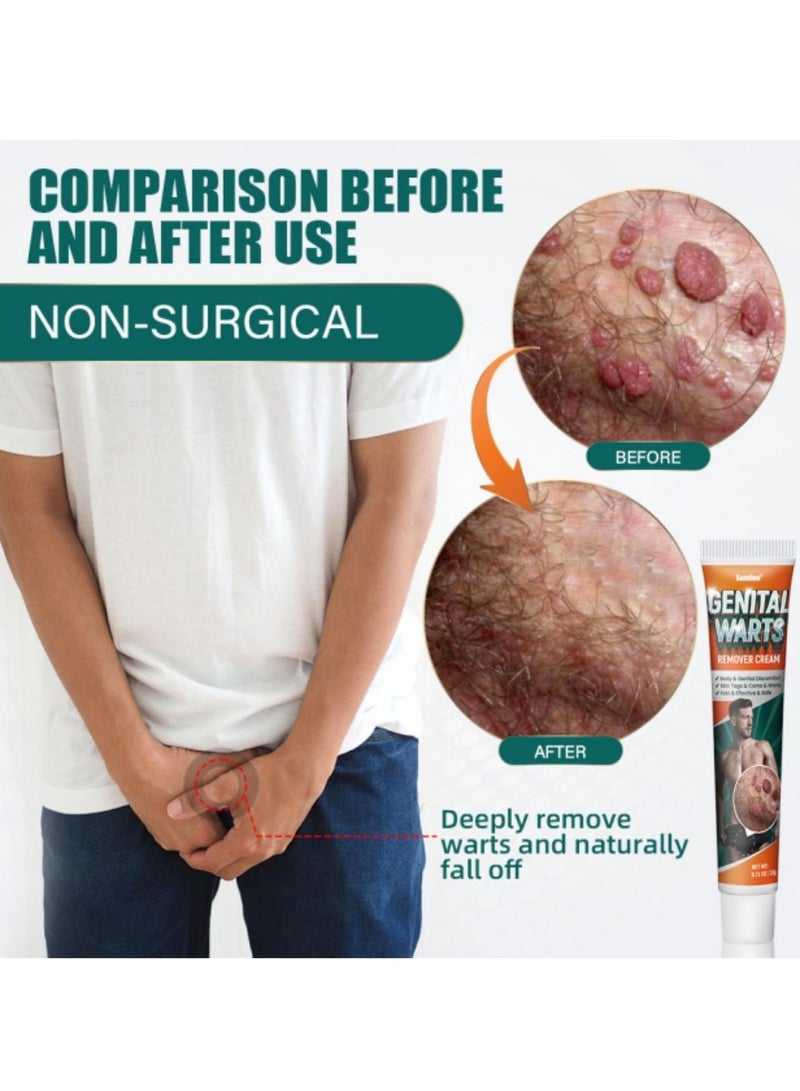 سوميفون مرهم إزالة الثآليل، محلول إزالة الثآليل، كريم إزالة الثآليل، كريم إزالة الثآليل المحمول اللطيف الآمن مع مستخلصات طبيعية لجميع أنواع البشرة، عالمي لكل من الرجال والنساء لإزالة الثآليل. حماية الصحة والجمال. - Image 3