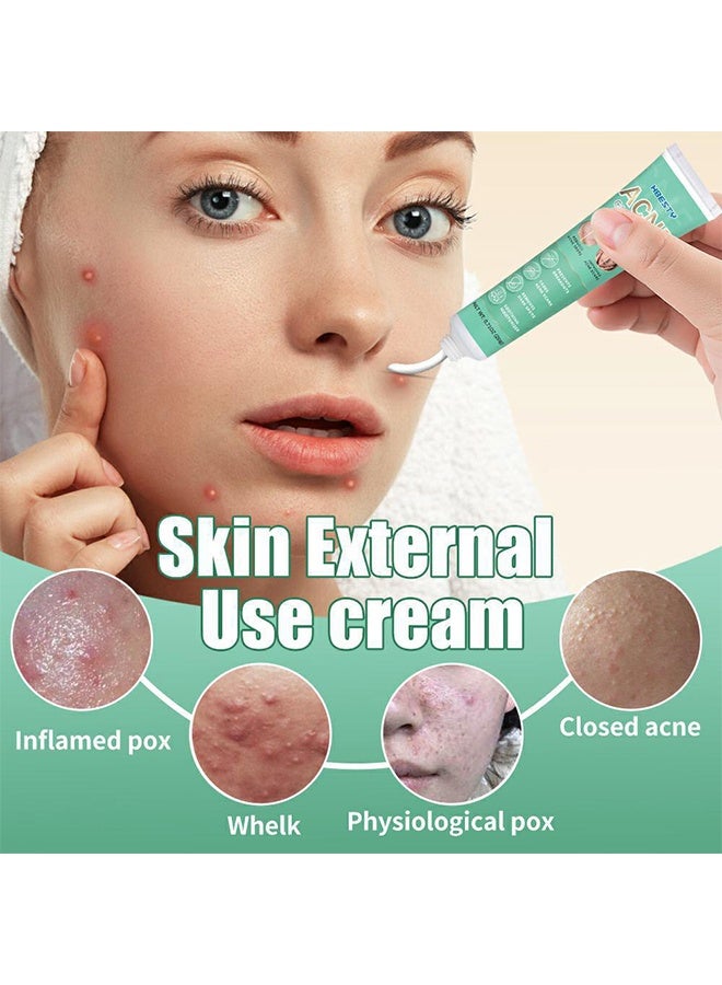 HBESTY Acne Care Cream, Acne Treatment Face Cream，Oil Control Anti Acne Facial Care ，Acne Spot ，Cystic Acne，Fungal Acne ，Face Acne Spot Treatment and Acne Scar Treatment Post Acne Marks Treatment，Pimple Remover， Acne Repair - Image 5