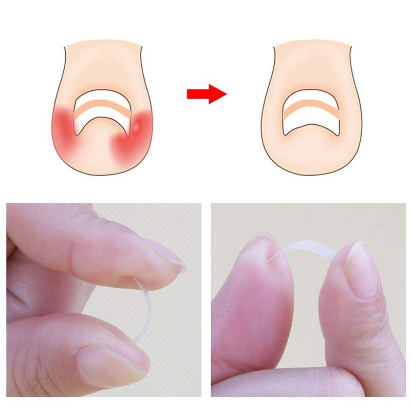 Gnker Ingrown Toenail Corrector Strips Brace 10pcs/bottle Straightener Clip Curved BS Brace Toenails Thick Correction Foot Tool - Image 3
