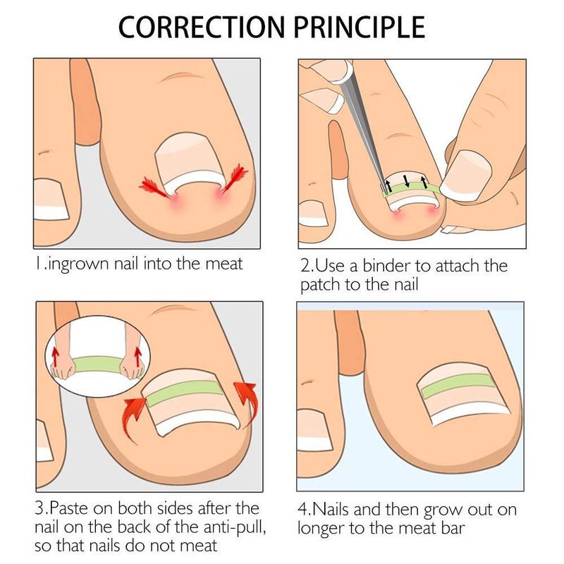 Gnker Ingrown Toenail Corrector Strips Brace 10pcs/bottle Straightener Clip Curved BS Brace Toenails Thick Correction Foot Tool - Image 5