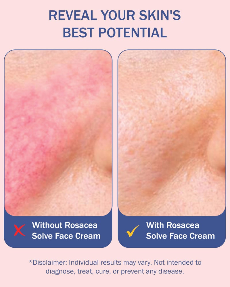 e70 Rosacea Treatment Skincare Face Wash for Women & Men - Gentle Face Cleanser Moisturizer Redness Reducing Skin Care with Aloe Vera, Hyaluronic Acid & Fruit Extracts, Made in USA (8 fl. oz) - Image 5