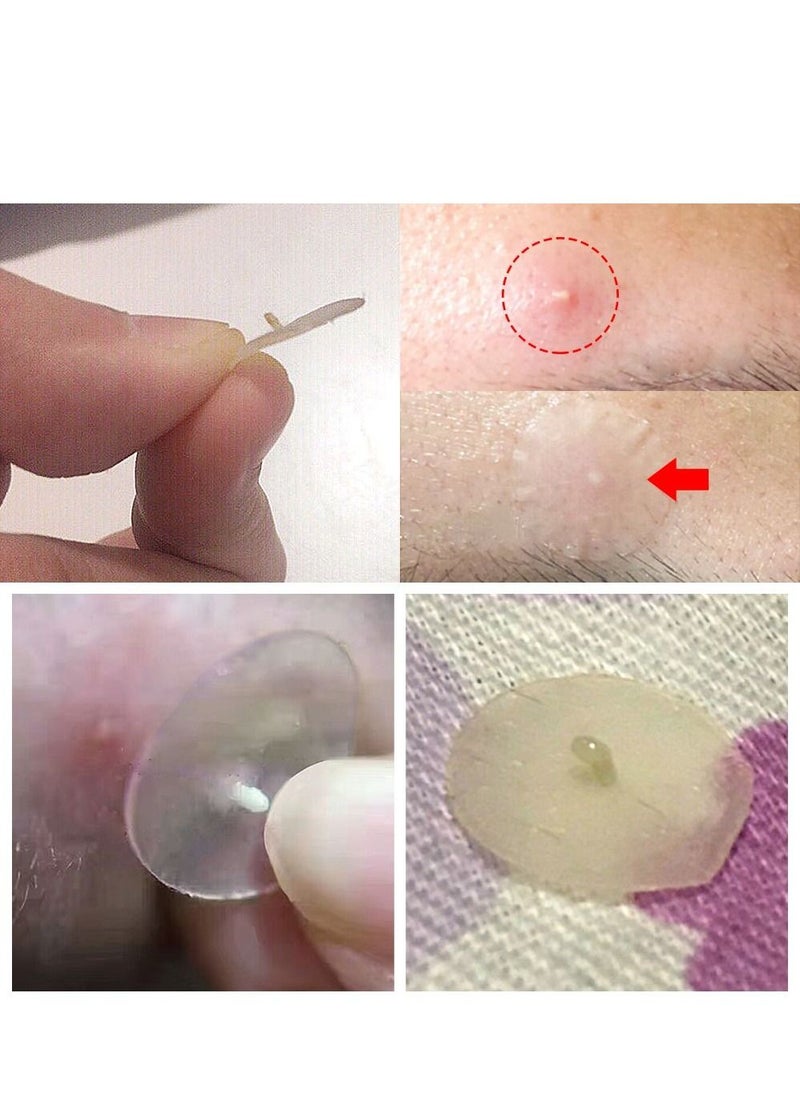 Breylee Acne Pimple Patch Stickers Acne Treatment Pimple Remover Tool Blemish Spot Facial Mask Skin Care Waterproof 22 Patches  - Image 5