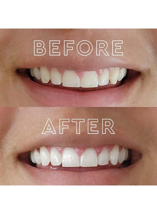 MOON Teeth Whitening Kit with LED Light, Wireless, 5 Minute Treatment, Gentle on Sensitive Teeth, Helps Remove Stains from Coffee, Smoking, Wine, Soda - Image 2