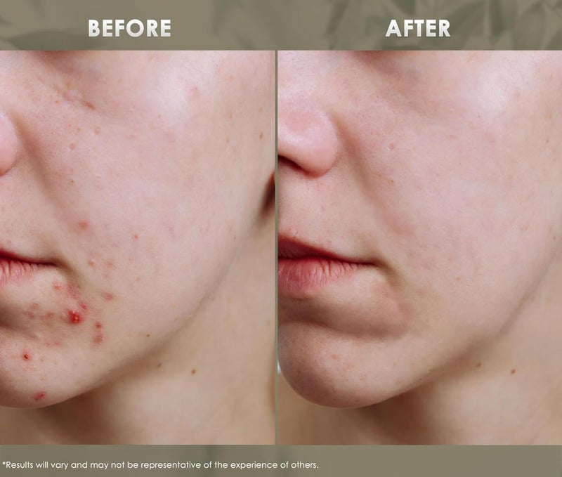 Redmint Acne Clear Facial Essential Oils Made with 100 Organic TCM Herbal Ingredients Skincare Natural Tried True Acne Face Oil Anti Acne Serum for Face to Skin Radiance 20ml - Image 5