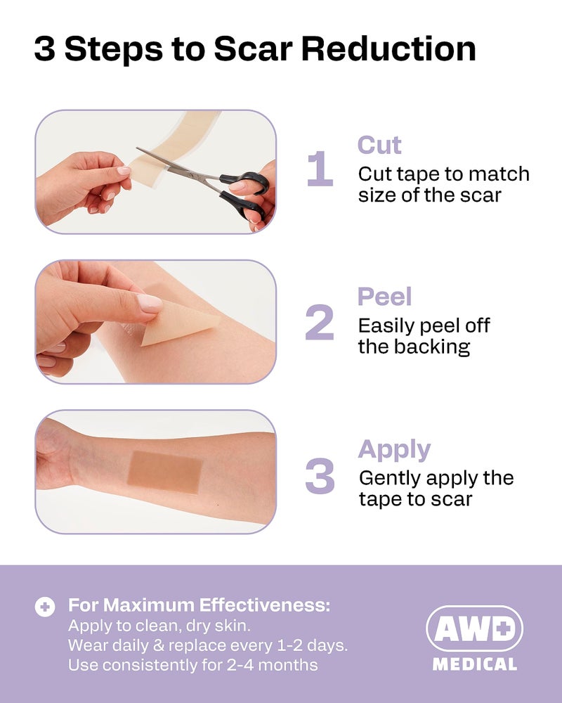 AWD Medical AWD Silicone Scar Tape Roll 60in â€“ Medical Grade Scar Tape for Surgical Scars, C Section, Tummy Tuck â€“ Reusable Silicone Scar Sheets for Keloid Bump Removal & Postpartum Essentials (60in) - Image 3