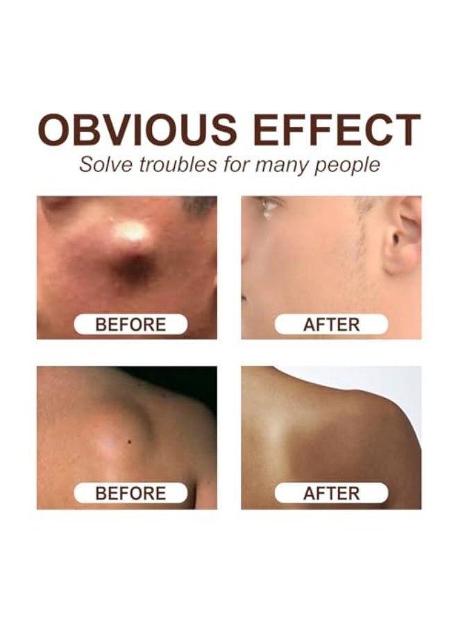 إيلهو كريم لتهدئة الأورام الشحمية، كريم إزالة الأورام الشحمية، كريم إزالة الأورام الشحمية الفوري، كريم إزالة الأورام الشحمية الخالي من الكتل، كريم إزالة الأورام الشحمية العشبي، كريم نباتي طبيعي لإزالة كتل الأورام الشحمية، 20 جرام - Image 4