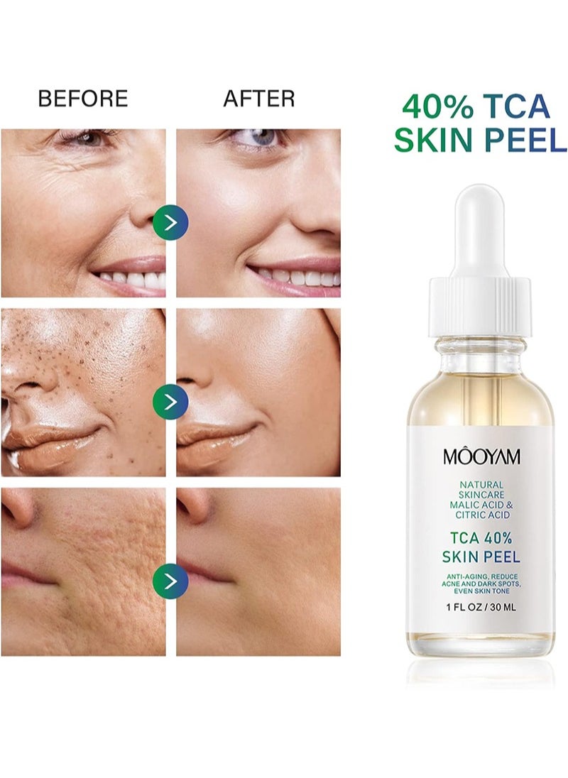 40% TCA Chemical Peeling Serum with Malic and Citric Acid for Dark Skin, Dark Spots and Acne Spots, Natural Skin Care - 30 ml/1 fl oz (TCA 40%)