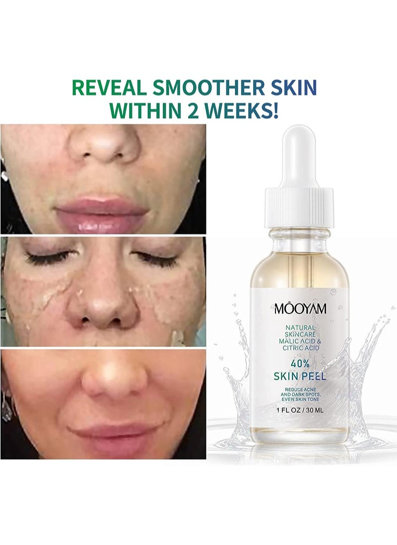 40% TCA Chemical Peeling Serum with Malic and Citric Acid for Dark Skin, Dark Spots and Acne Spots, Natural Skin Care - 30 ml/1 fl oz (TCA 40%)