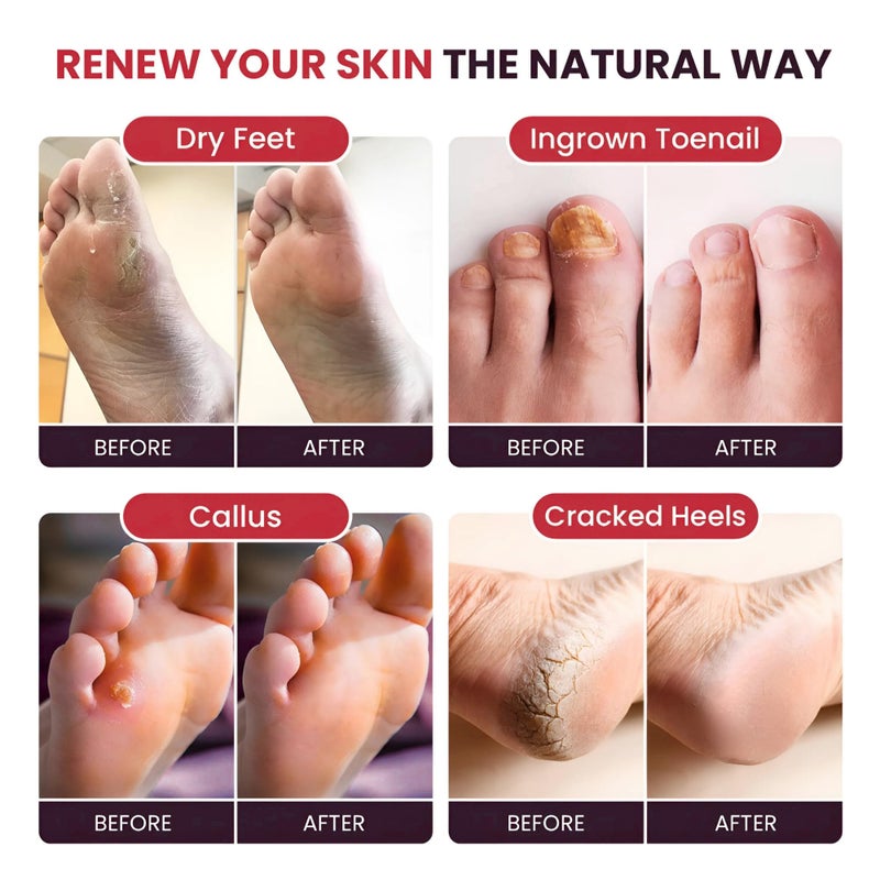 Foot Cure علاج القدم زيت شجرة الشاي ونقع القدم بالعضلات مع أملاح إبسوم - أملاح طبيعية بالكامل للتعافي بعد التمرين - يلين الكالو، يهدئ القدمين المتعبة والمؤلمة، التحكم في رائحة القدم، باديكير سبا (عبوة من 2) - Image 5