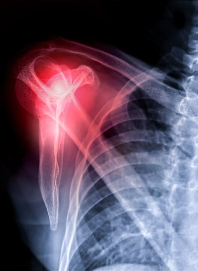 move Humeral Brace for Upper Arm Fracture Immobilization – MV008 - Image 4