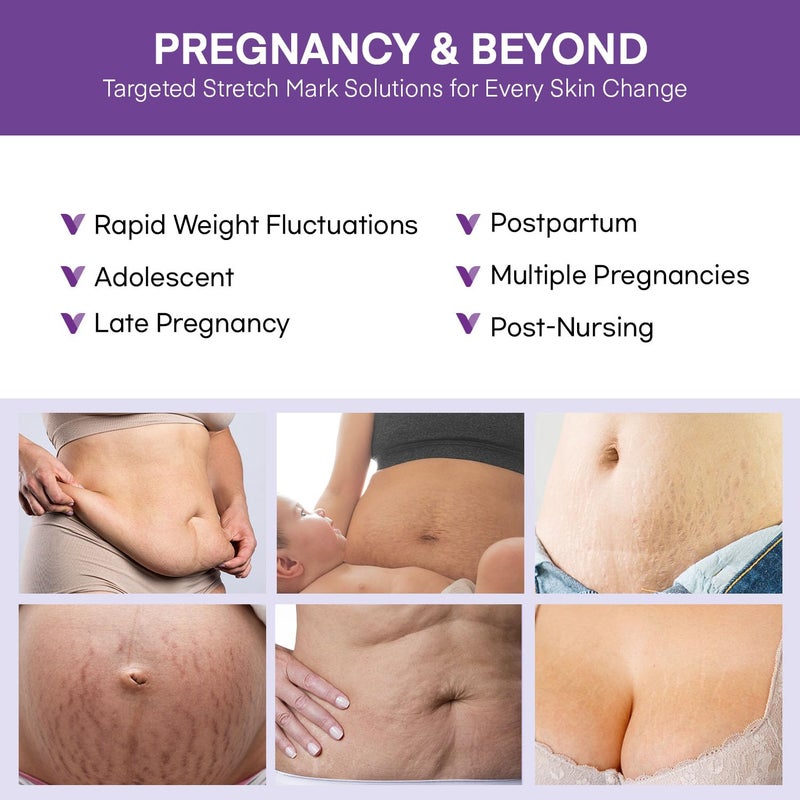 VIGORITY Stretch Mark Cream for Pregnant Women: Stretch Mark Treatment for Pregnancy - Belly Butter For Pregnant Women - Massage Lotion To Prevent And Repair Maternity Stretch Marks Scar - 4 Oz - Image 4