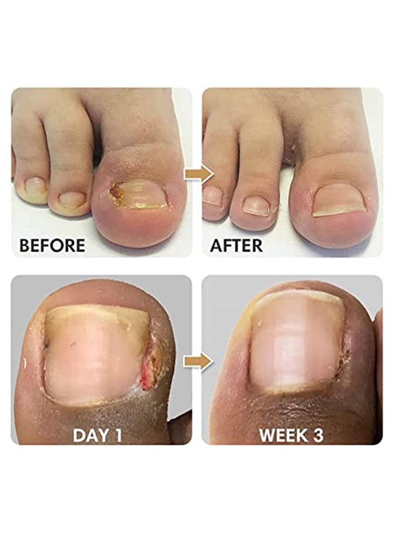 EELHOE 100 Pieces  Ingrown Toenail Correction Stickers Toenail Corrector Patch Glue free Ingrown Toenail Corrector Strips Toe Nail Correction File Patches Relieve Nail Groove Unisex - Image 4