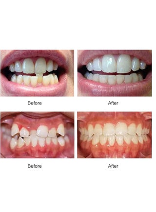 New Transparent braces, orthodontics, three-stage rapid tooth