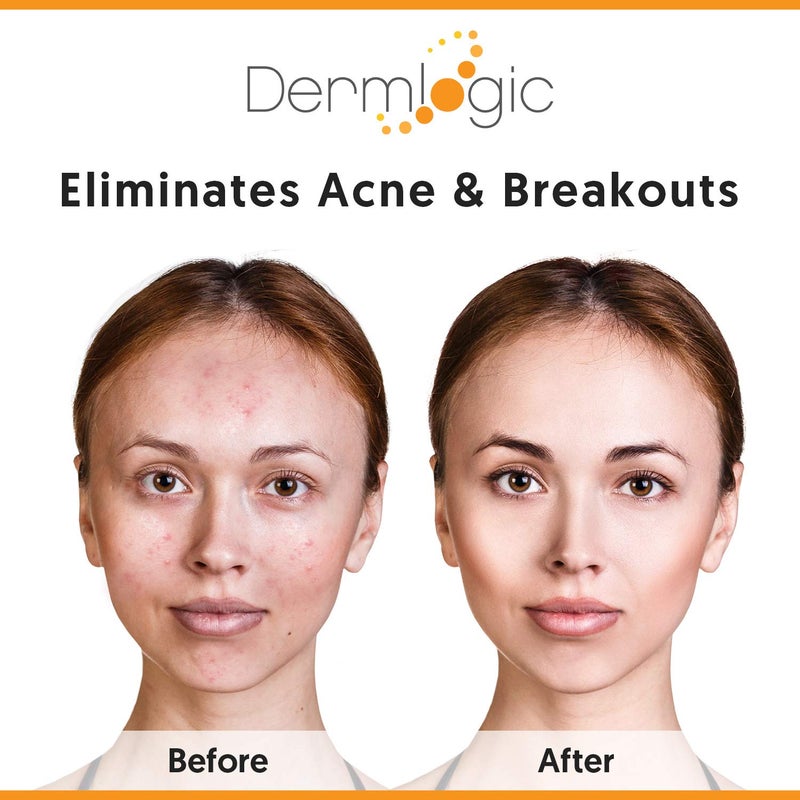 Dermlogic Acne Treatment Pads-Contains Glycolic, Lactic, Salicylic Acid. Eliminates Oily Skin, Clogged Pores & Cystic Breakouts. Removes Dark Spots, Whitehead & Blackhead Pimples for Face & Body. - Image 3