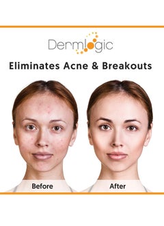 Dermlogic Acne Treatment Pads-Contains Glycolic, Lactic, Salicylic Acid. Eliminates Oily Skin, Clogged Pores & Cystic Breakouts. Removes Dark Spots, Whitehead & Blackhead Pimples for Face & Body.  - Image 3