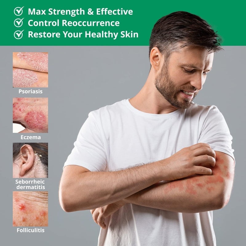 Hermon Psoriasis Eczema Relief Cream Maximum Strength for Psoriasis Eczema  Relieve Symptom of Resistant Effective for Seborrheic Dermatitis Folliculitis 100m 34 Fl Oz Pack of 1 - Image 2
