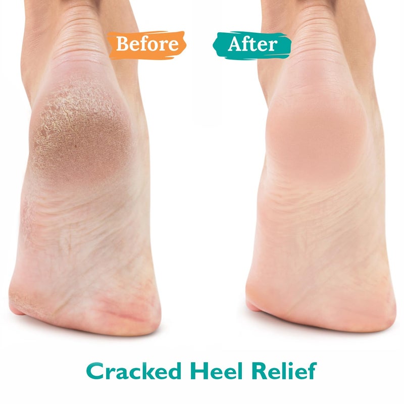 GILDEN TREE Urea Gel 42 Percent For Feet Maximum Strength Softens Cracked Heel Calluses & Thick Toenails - Image 2