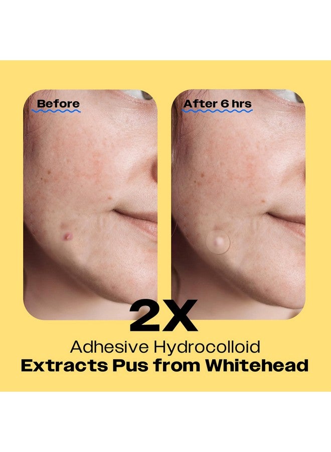 AVARELLE Acne Cover Patch Now Zitout (40 Patches) Hydrocolloid Acne Pimple Patches Acne Patches For Face Blemishes And Breakouts Tea Tree Calendula. Cica Vegan Cruelty Free Carbonfree - Image 3