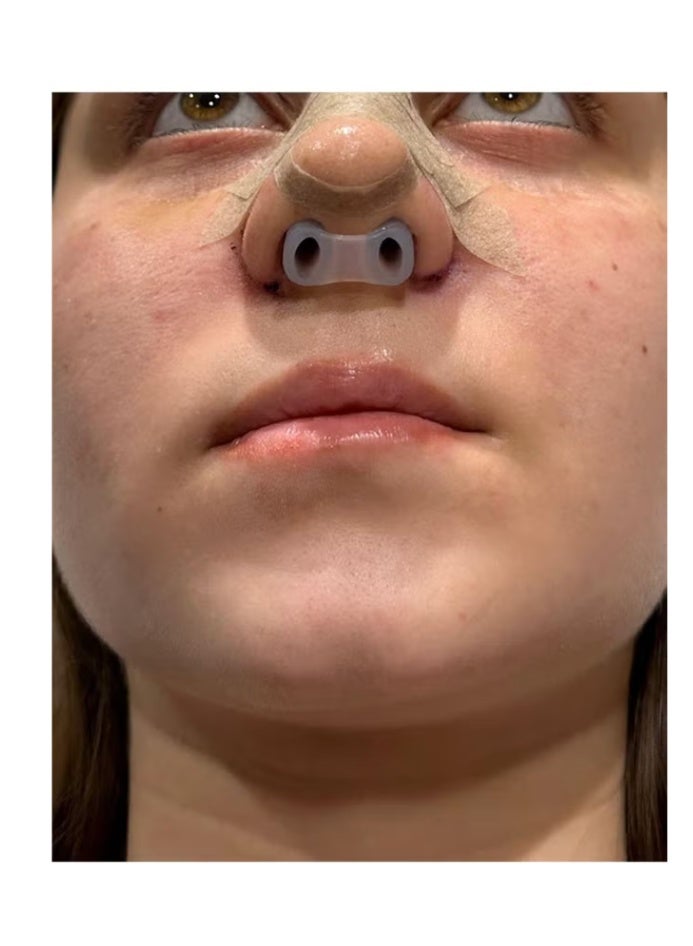 (No. 6 No. 7 .)Face healthly Silicone Nostril Retainer, Nose Pad for Surgery, Nose Retainer Rhinoplasty, Retainer for Work Surgery,%100 Silicone Nose Stud - Image 4