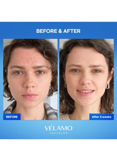 VELAMO ADVANCED Dark Spot Remover for Face and Body: Dark Spot Corrector Serum - Freckle/Melasma/Sun Spot/Age Spot/Brown Spot Remover 1 FL OZ/30mL  - Image 4