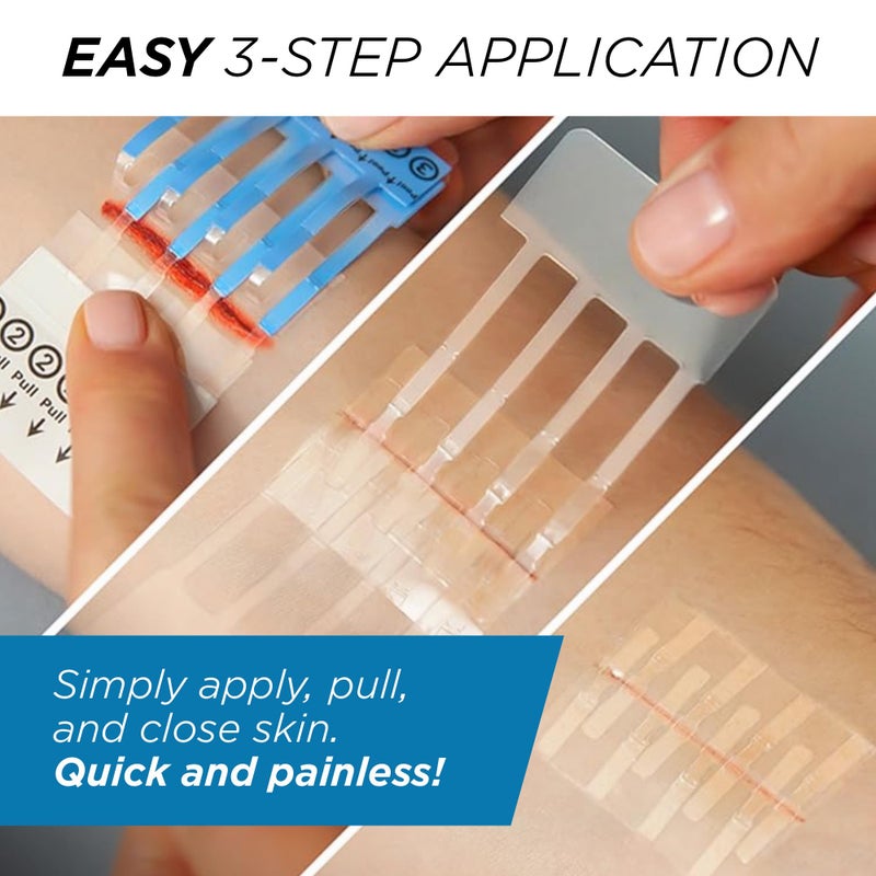 Clozex Emergency Laceration Kit - Repair Wounds Without Stitches, Skin Closure Device for a Wound Up to 1 1/2 Inches Length. Complete Kit to Clean, Close, & Cover Wounds - Image 5