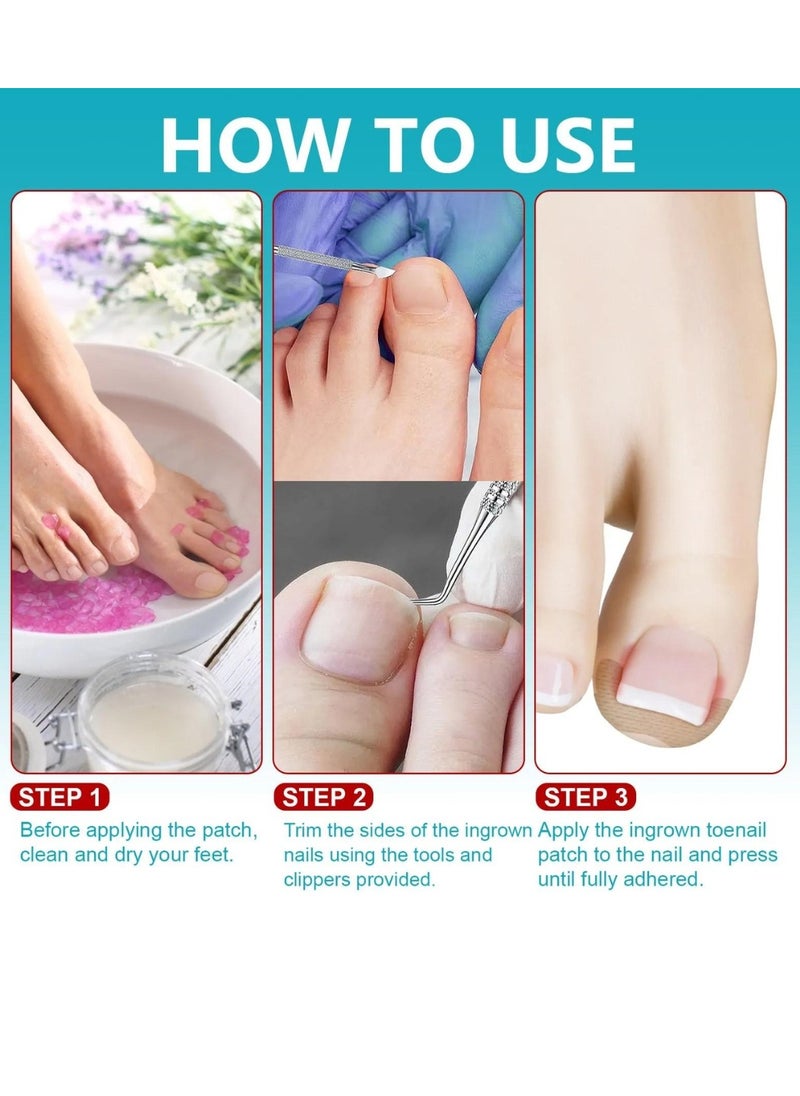 120 pcs Ingrown Toenail Corrector Patches with 2 Manicure Tools Ingrown Toenail Correction Stickers for Toenail Repair Glue Free Ingrown Toenail Corrector Strips Toenail File Patches