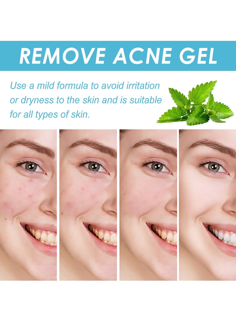 OUHOE - Salicylic acid acne repair gel. Repair facial closed comedones. Fade acne marks and blackheads. - Image 1