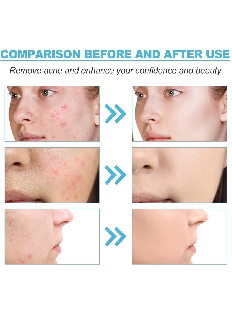 OUHOE - Salicylic acid acne repair gel. Repair facial closed comedones. Fade acne marks and blackheads. - Image 1