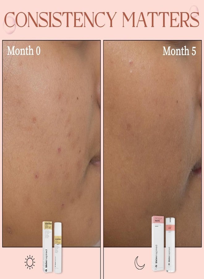 SkinInspired AHA+BHA+PHA Lactic Acid + 2% Salicylic Acid Face Serum| Exfoliating Serum For All Skin Types | Pore Cleansing Face | Reduces Acne & Blackheads | Peeling Solution For Glowing Skin 30ml - Image 2