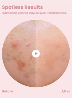 Glam Up Hydrocolloid Blemish Pimple Zit Patches - Invisible Ultra Thin Spot Cover Stickers for Face and Skin, Strong Water-proof and Adhesive Overnight Thin & Invisible (72 Count / 2 Sizes)  - Image 3