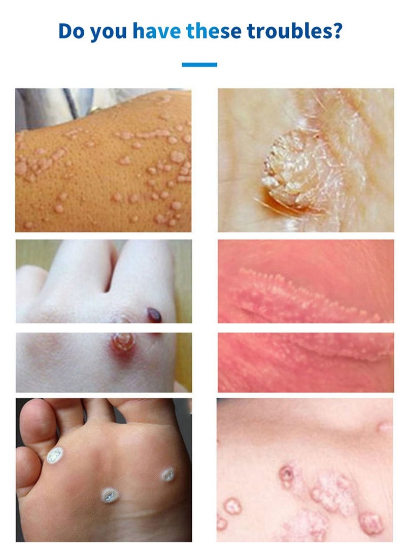 HEALMUSZ مزيل الثآليل آمن وفعال بتركيبة عشبية طبيعية عالية الامتصاص سريع المفعول يوقف نمو الثآليل غير المهيج لجميع أنواع البشرة النوع 10 مل - Image 3