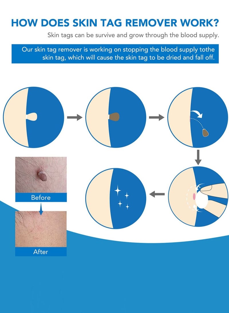 Sefudun أداة إزالة الثآليل 2 في 1 مجموعة إزالة علامات الجلد مزدوجة الرأس جهاز سهل الاستخدام خالي من الألم للعلامات الجلدية الصغيرة إلى الكبيرة على الوجه والرقبة والجسم باللون الأزرق - Image 2