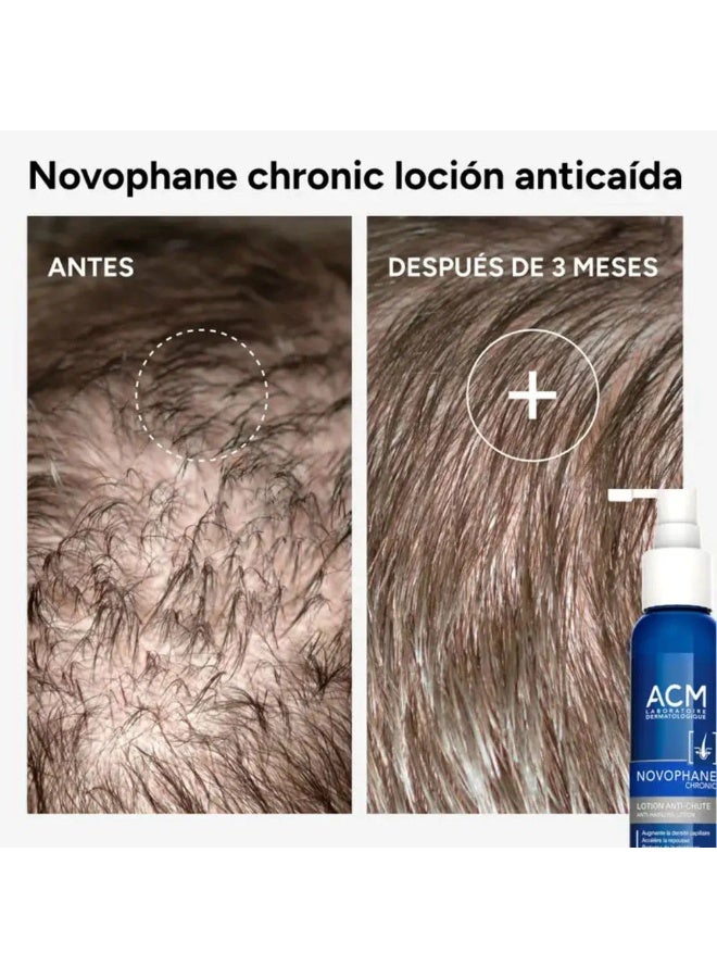 أيه سي أم لوشن ACM Novophane Chronic لمكافحة تساقط الشعر – ١٠٠ مل | يعزز كثافة الشعر، يسرع نموه، ويقوي البصيلات – للرجال والنساء - Image 2