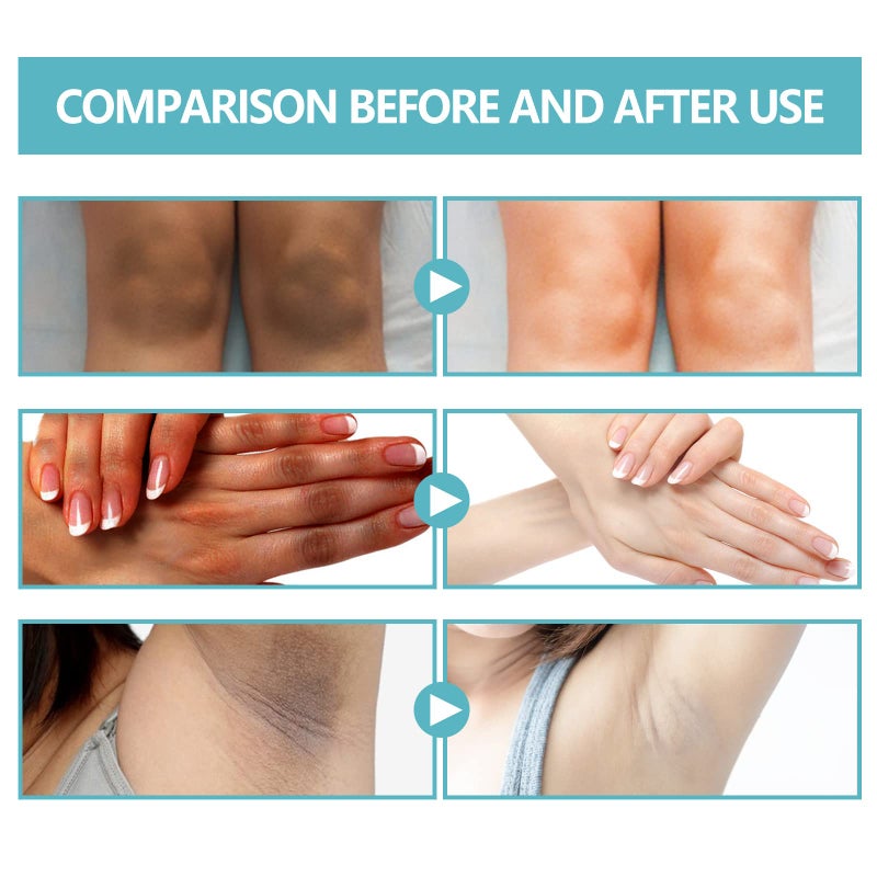 Nigrifix Acanthosis Nigricans Therapy Cream,Dark Spot Remover For Body,Dark Spot Corrector Cream,- Underarm, Neck, Armpit, Knees, Elbows, Private Areas, Intimate Areas - Upgraded Formula, - 2.1Fl Oz - Image 5
