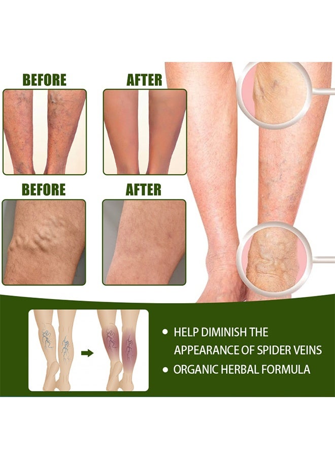 HBESTY Varicose Veins Cream, Soothing Leg Cream, Varicose And Spider Veins Treatment Cream, Improve Blood Circulation, Fast Relieve Swelling Pain 50G - Image 5