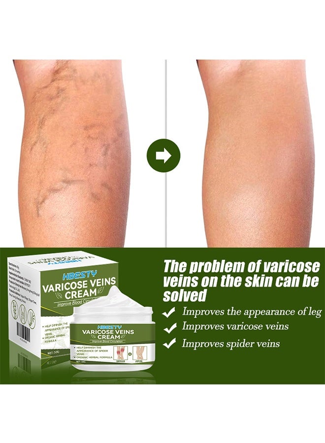 HBESTY Varicose Veins Cream, Soothing Leg Cream, Varicose And Spider Veins Treatment Cream, Improve Blood Circulation, Fast Relieve Swelling Pain 50G - Image 2