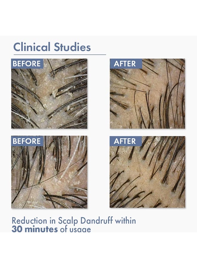 ThriveCo Anti Dandruff Hair Serum Pre-Shampoo Dandruff Treatment for Itchy, Dry & Flaky Scalp | With Octopirox, Pentavitin & Arginine | Reduces Hair Breakage & Strengthens Hair for Men & Women | 10ml - Image 3